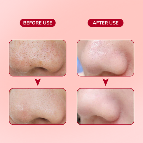 Charcoal-Based Nose Strips